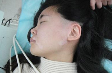 武汉治疗白斑医院：女性白斑患者要怎么做护理