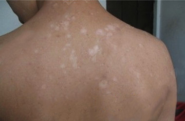 武汉治疗白斑医院讲解背部白斑的症状表现