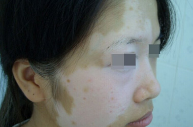 武汉白斑医院：哪种方法更适合治疗面部的白斑