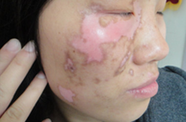 武汉白斑医院：女性白斑患者可不可以化妆?