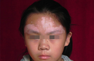 武汉白斑专科医院：儿童白斑患者日常如何注意?