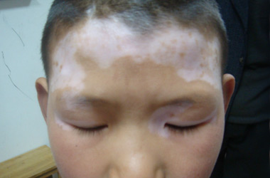 武汉白斑医院：脸部白斑的护理方法有什么呢?