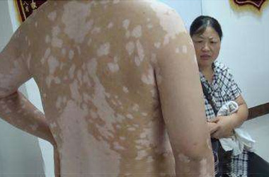 武汉白斑医院：男性患白斑的危害是什么?