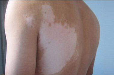 武汉白斑医院：背部白斑的发病原因是什么？