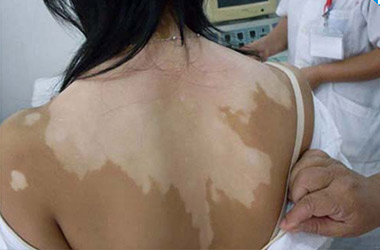 武汉白斑医院：背部白斑的发病原因是什么？