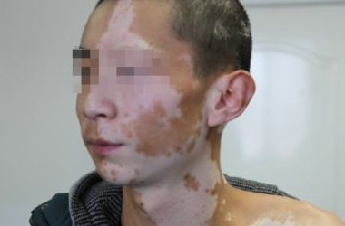武汉白斑医院：男性白斑患者如何进行护肤?