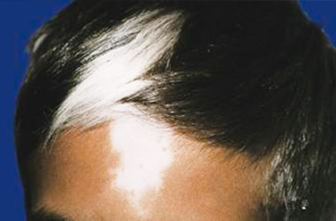 头部患白斑的诱因是什么呢?
