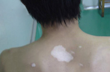 背部出现白斑的病因是什么?