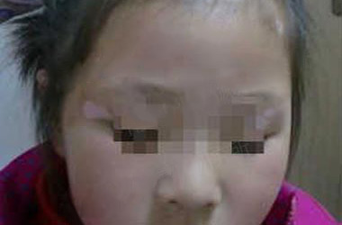 儿童患白癜风初期症状的6个表现