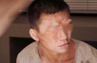男性面部患上白癜风该如何治疗?