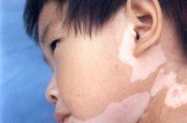 武汉儿童白癜风白斑易诱发的原因是什么?